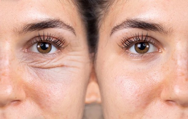 Tired Eyes Making You Look Exhausted? Real Solutions That&nbsp;Work